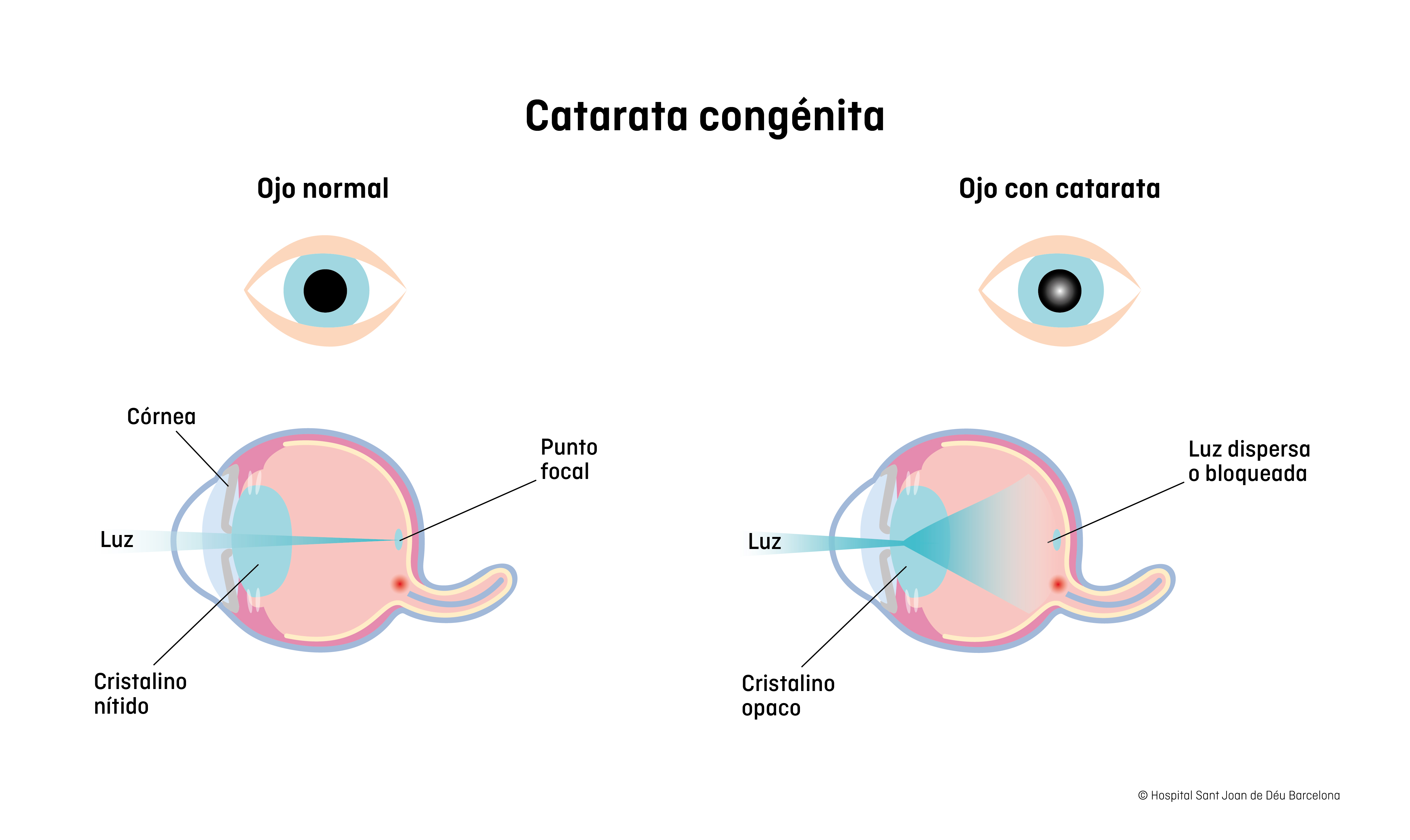 Catarata congénita