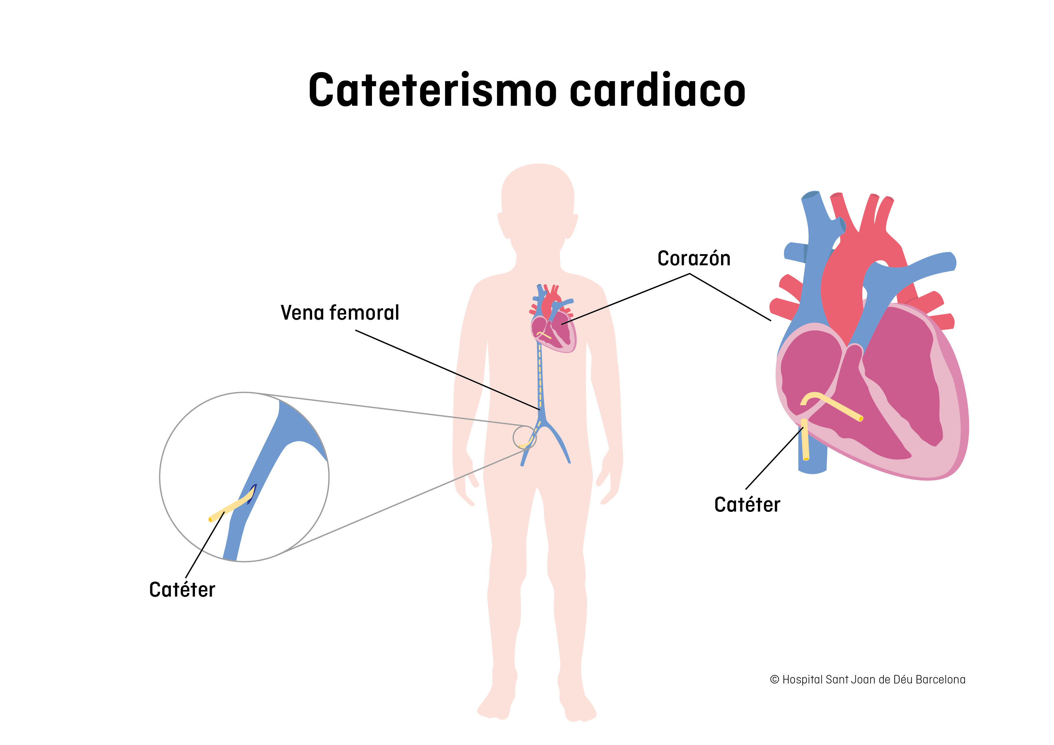 Cateterismo cardíaco