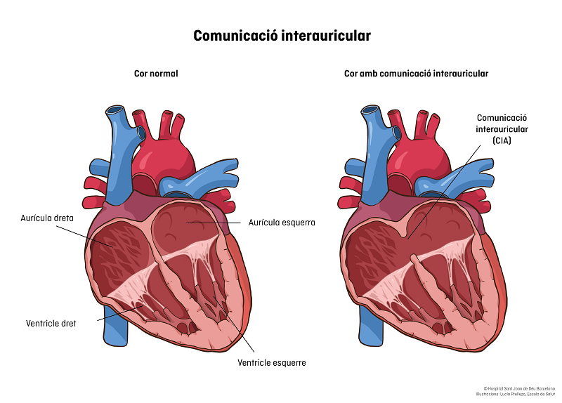comunicació interauricular