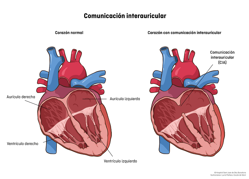 comunicación interauricular