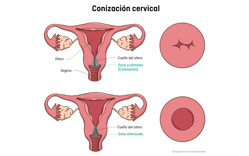 conización cervical