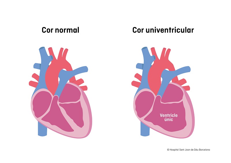 cor univentricular