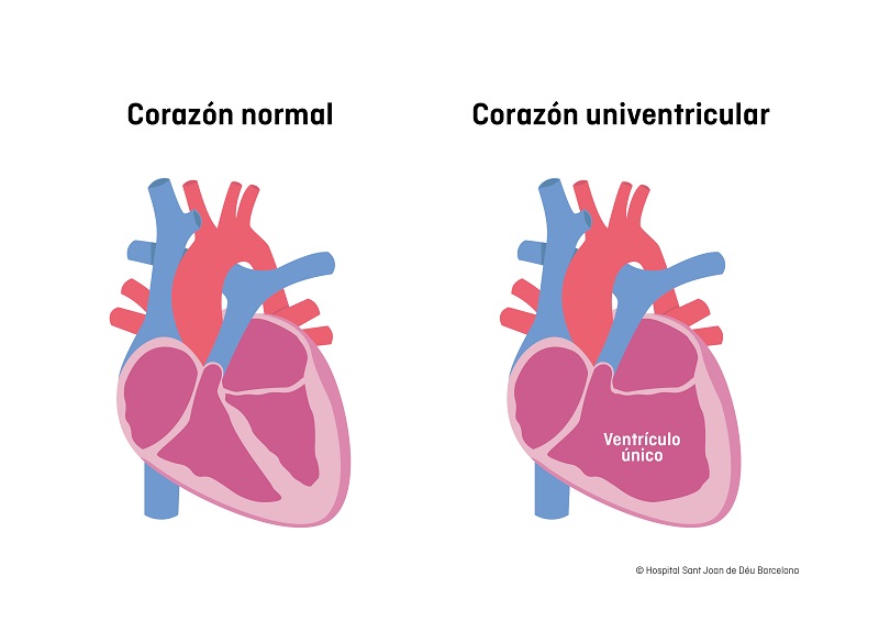 corazón univentricular