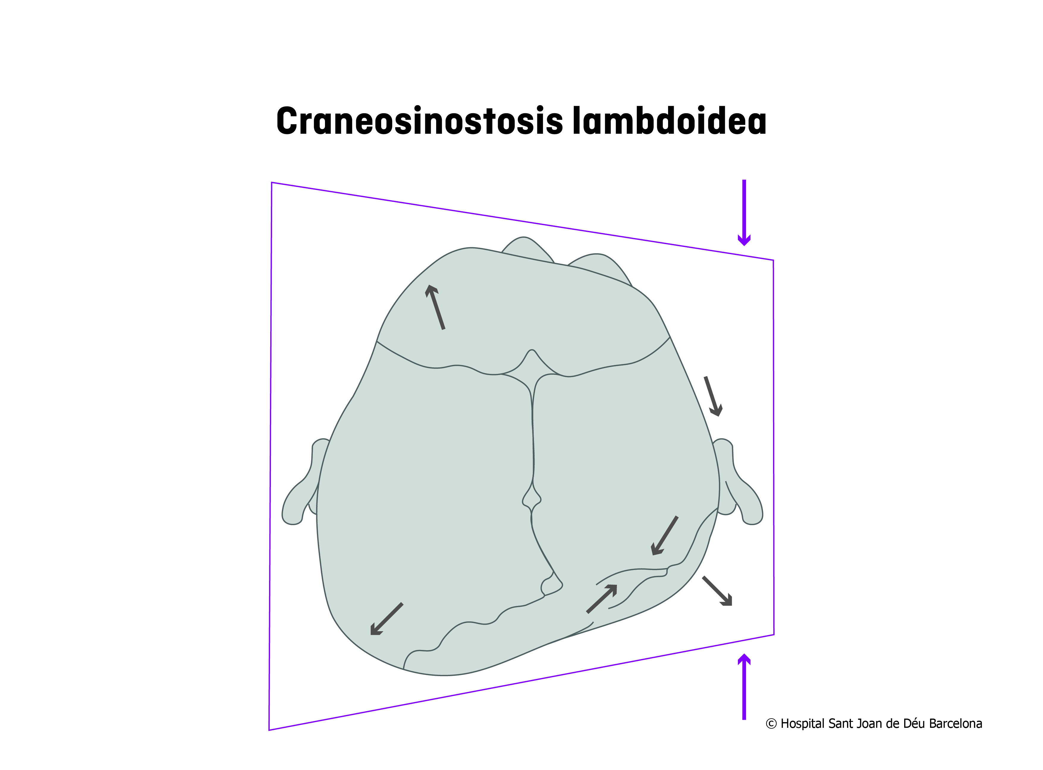 Craneosinostosis lambdoidea