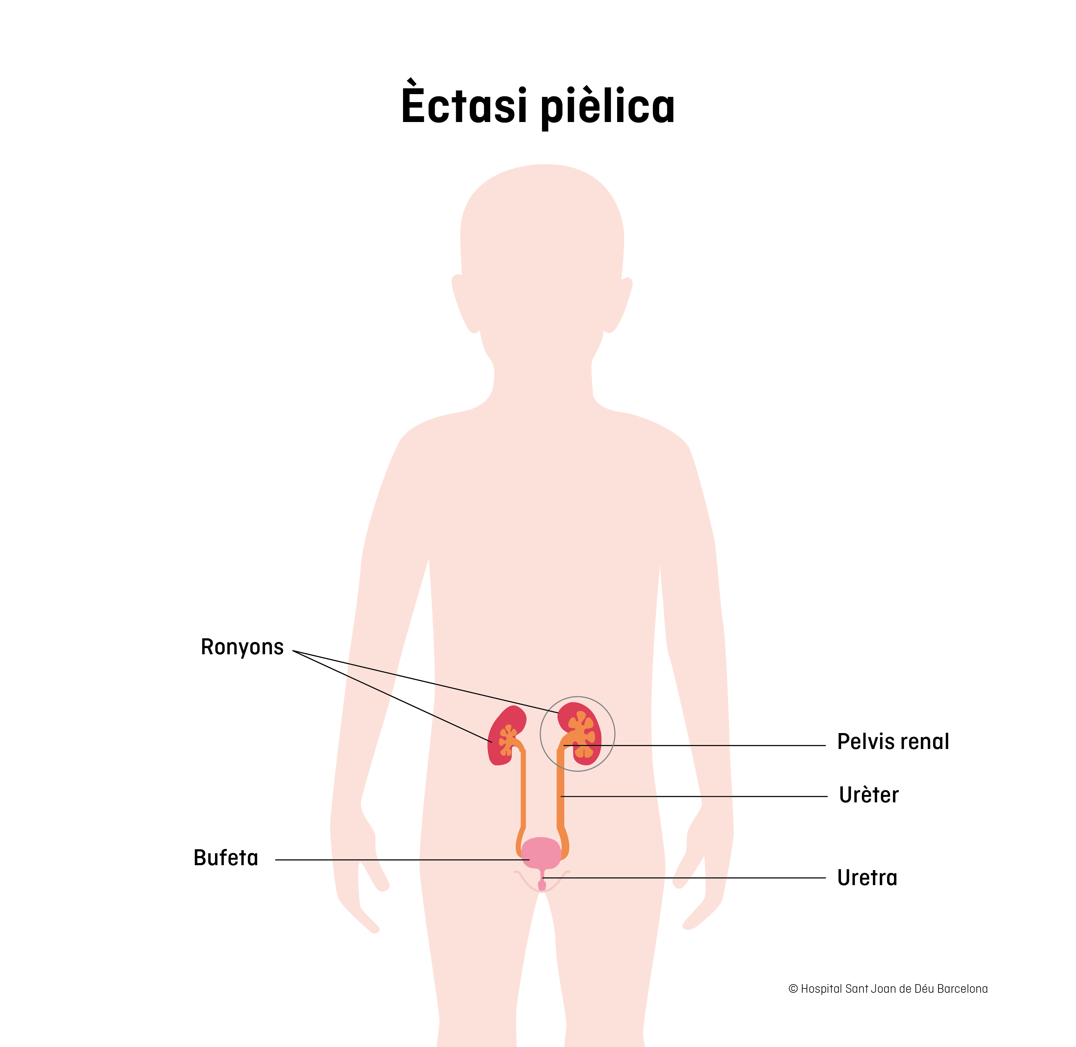 Èctasi pièlica