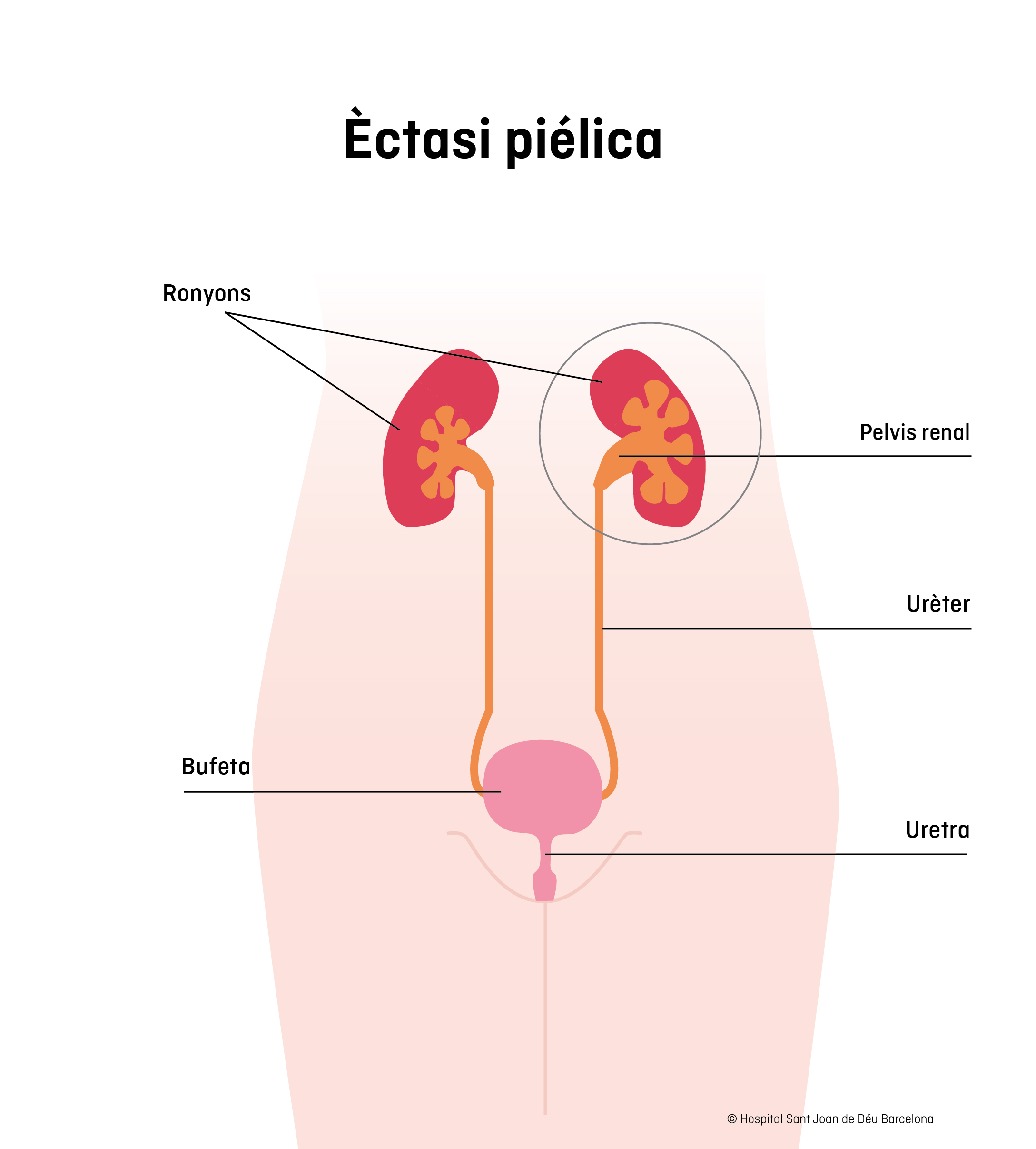 Ectasia pièlica