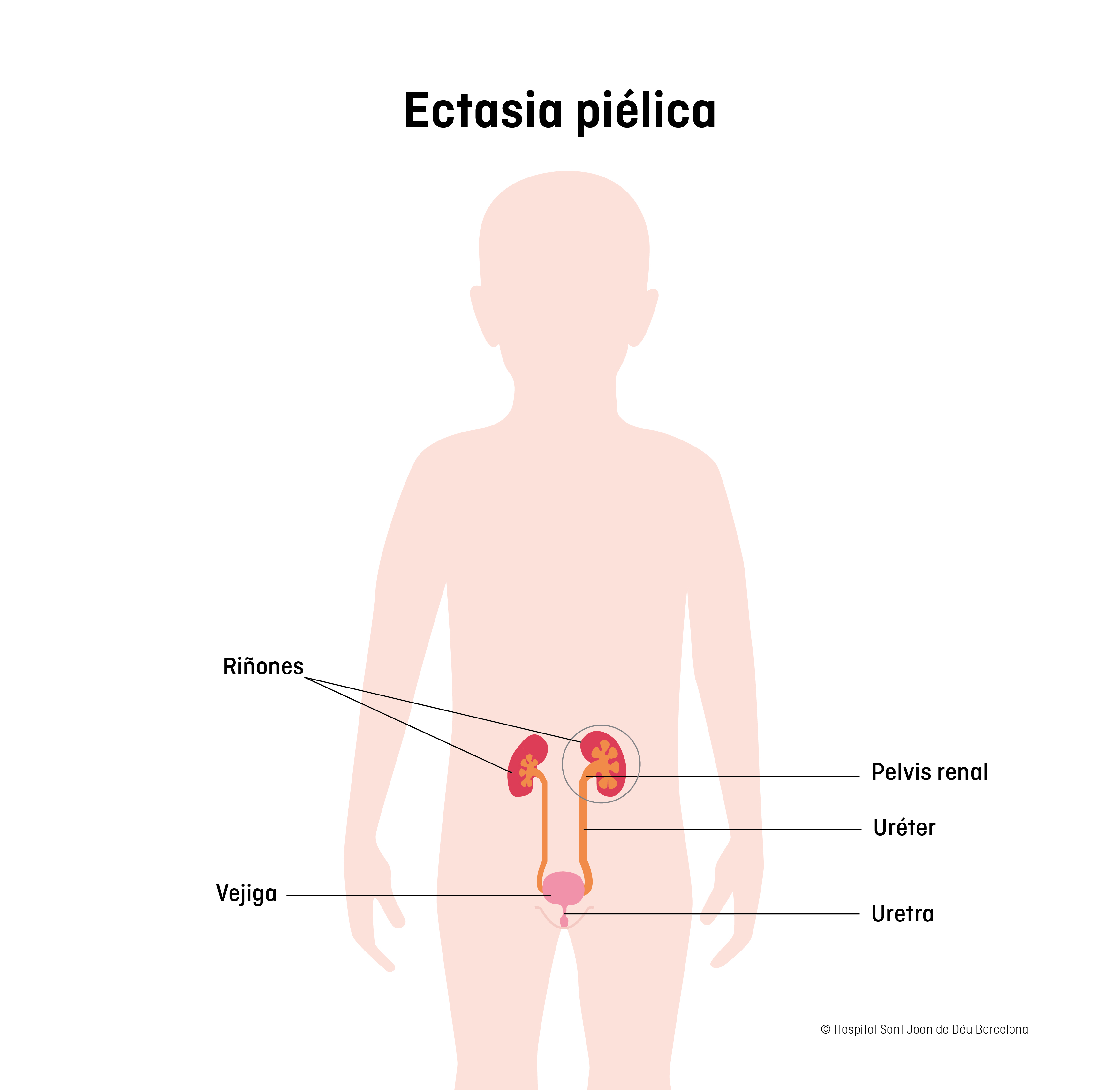 Ectasia piélica