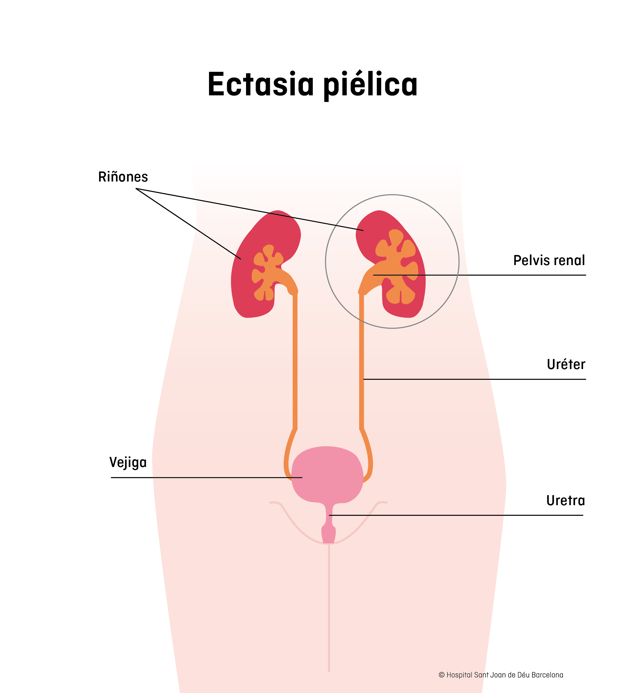 Ectasia piélica