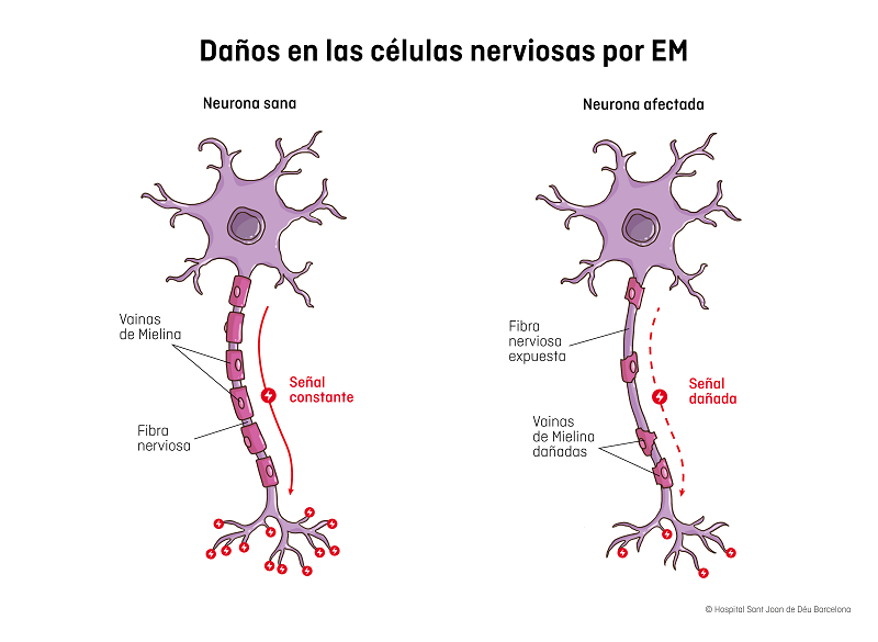 esclerosis múltiple