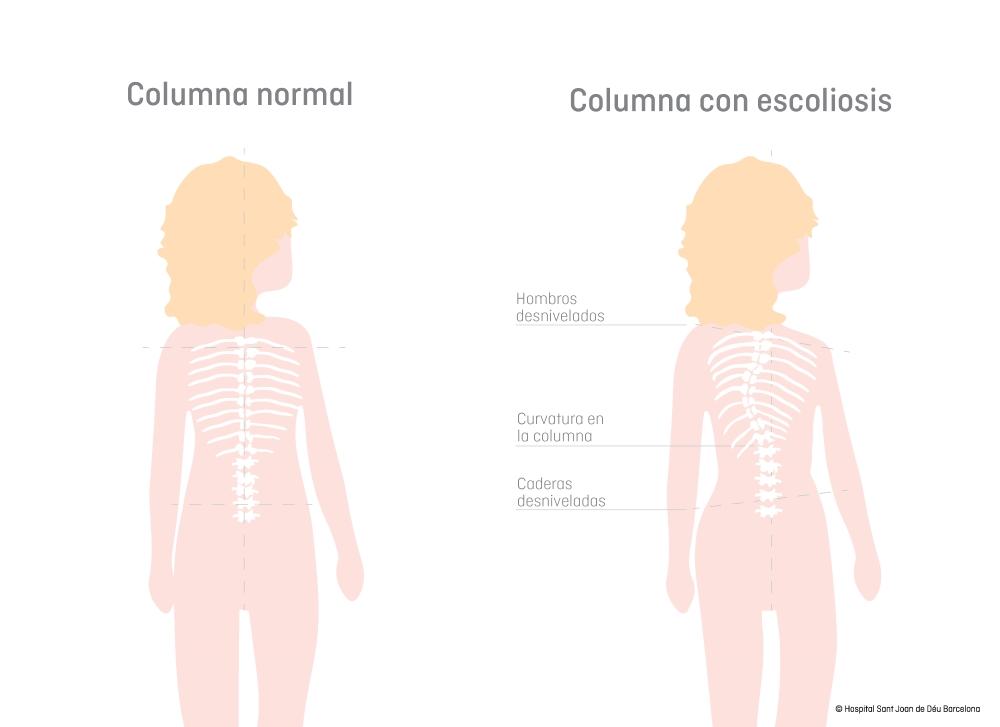 Dibujo de niña con escoliosis