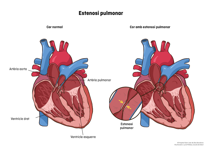 Estenosi de la vàlvula pulmonar
