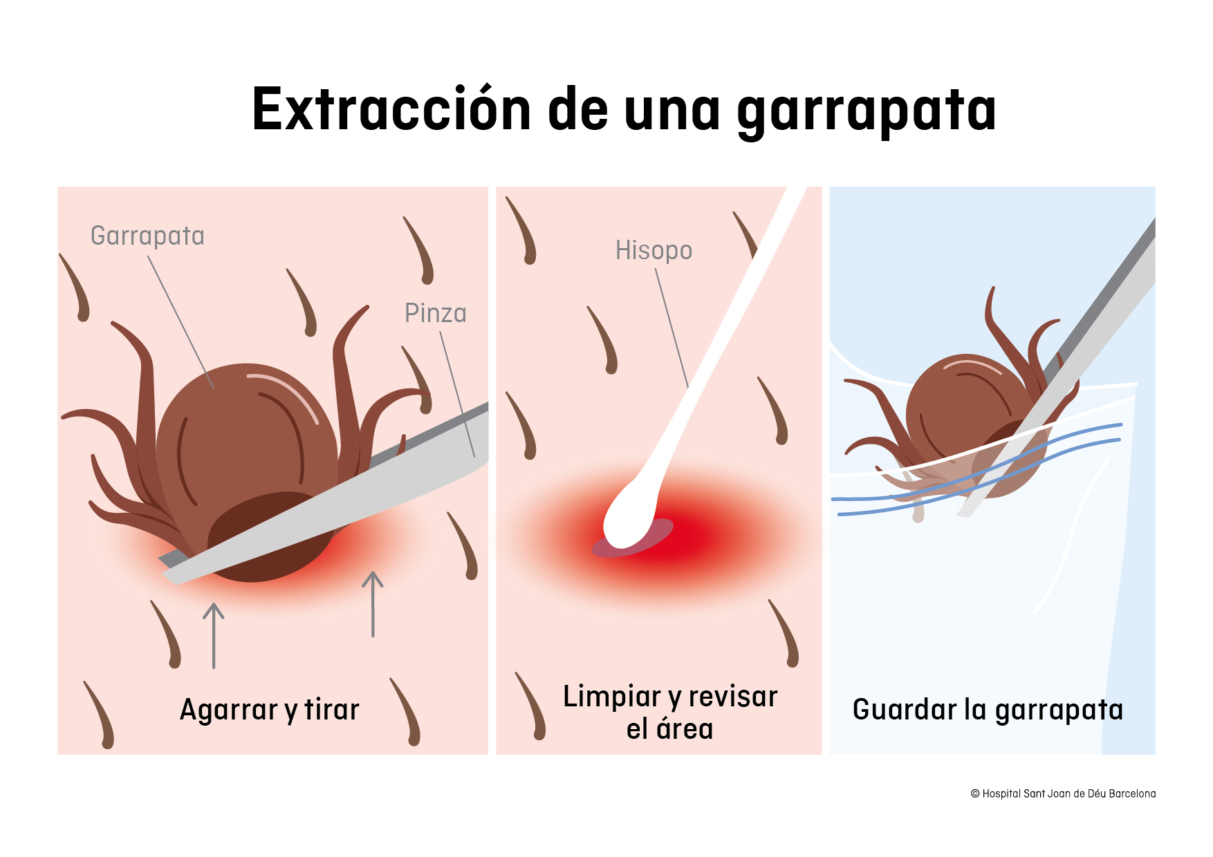 Infografía de la extracción de una garrapata