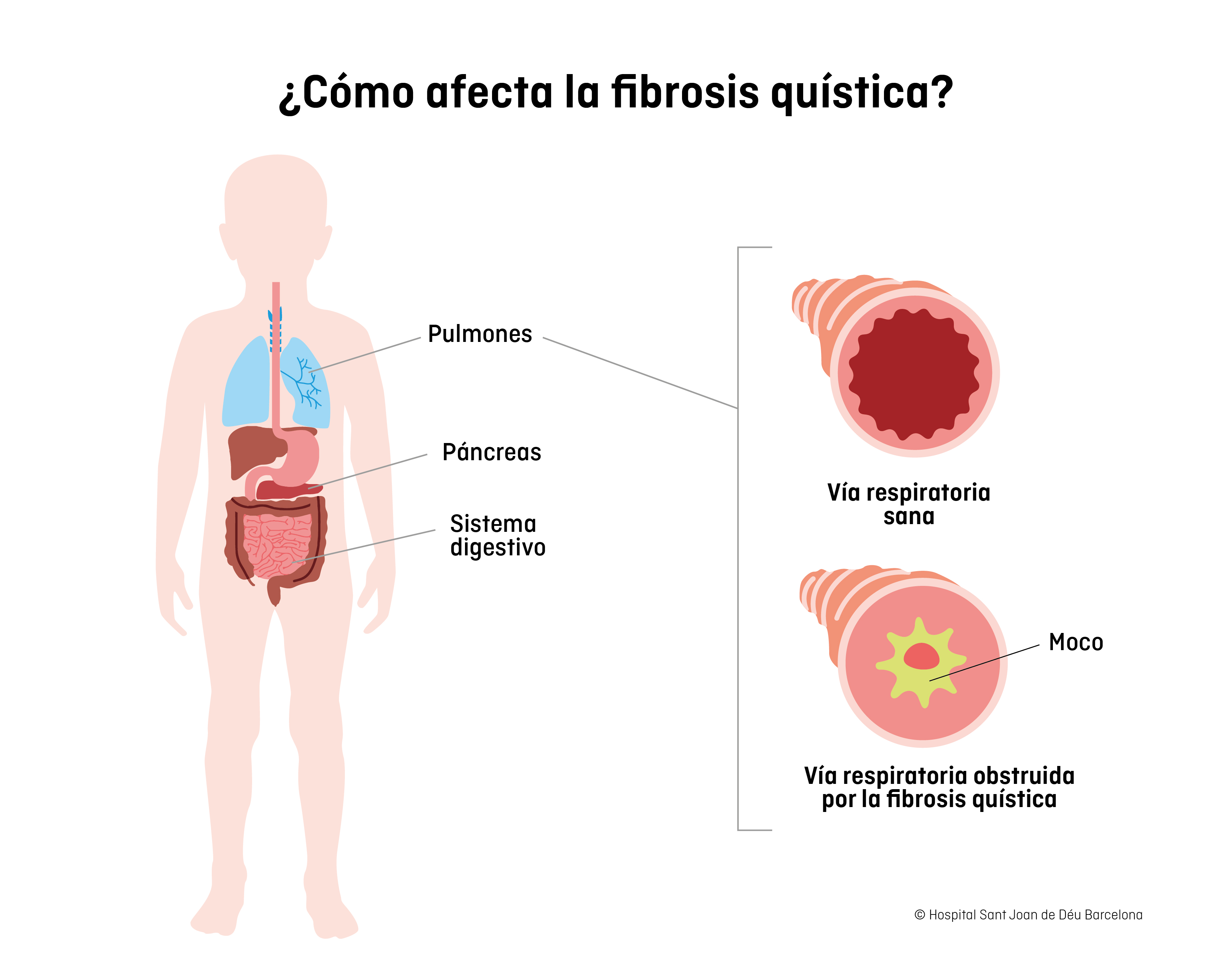 Afectación de la fibrosis quística 