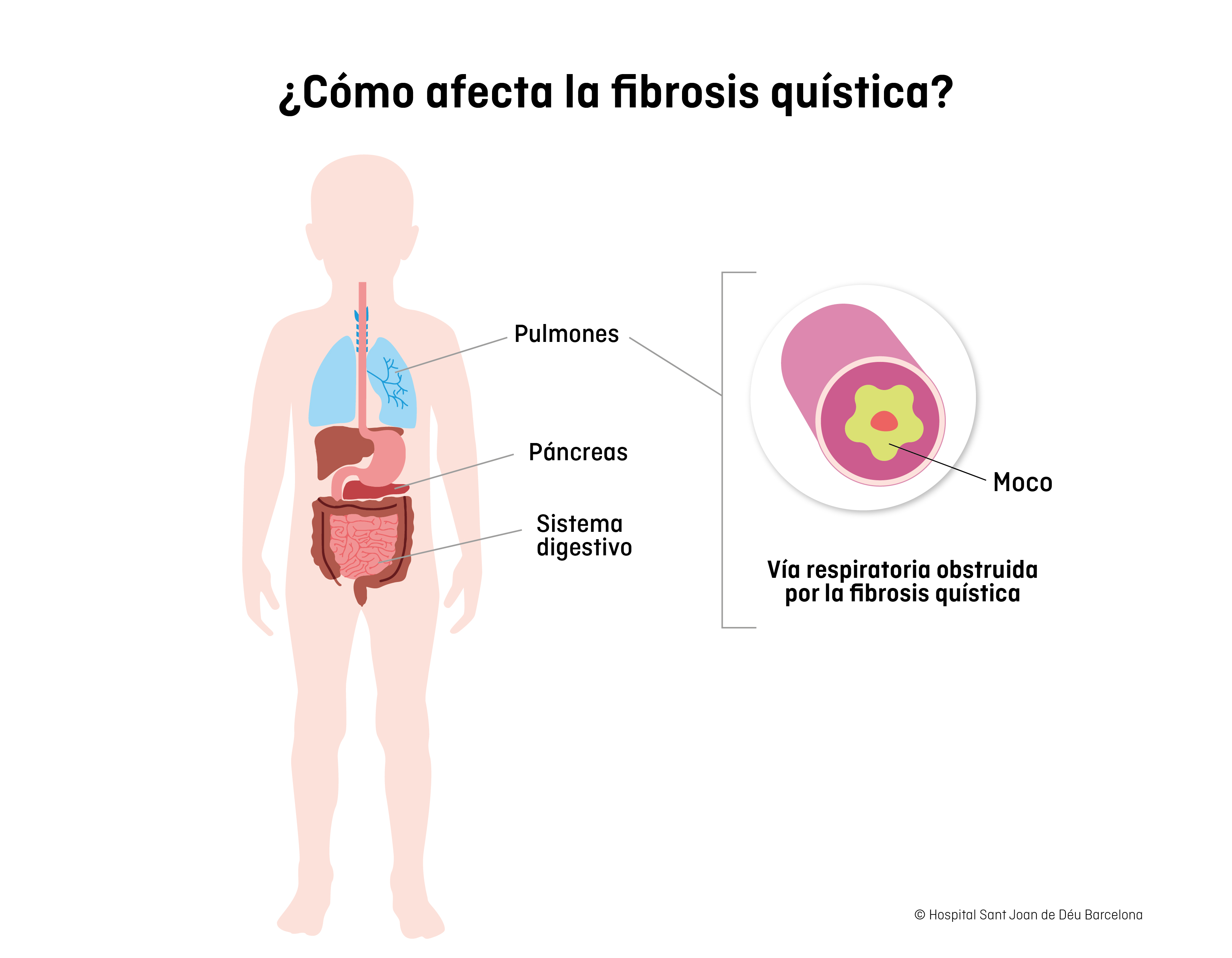 Fibrosis quística