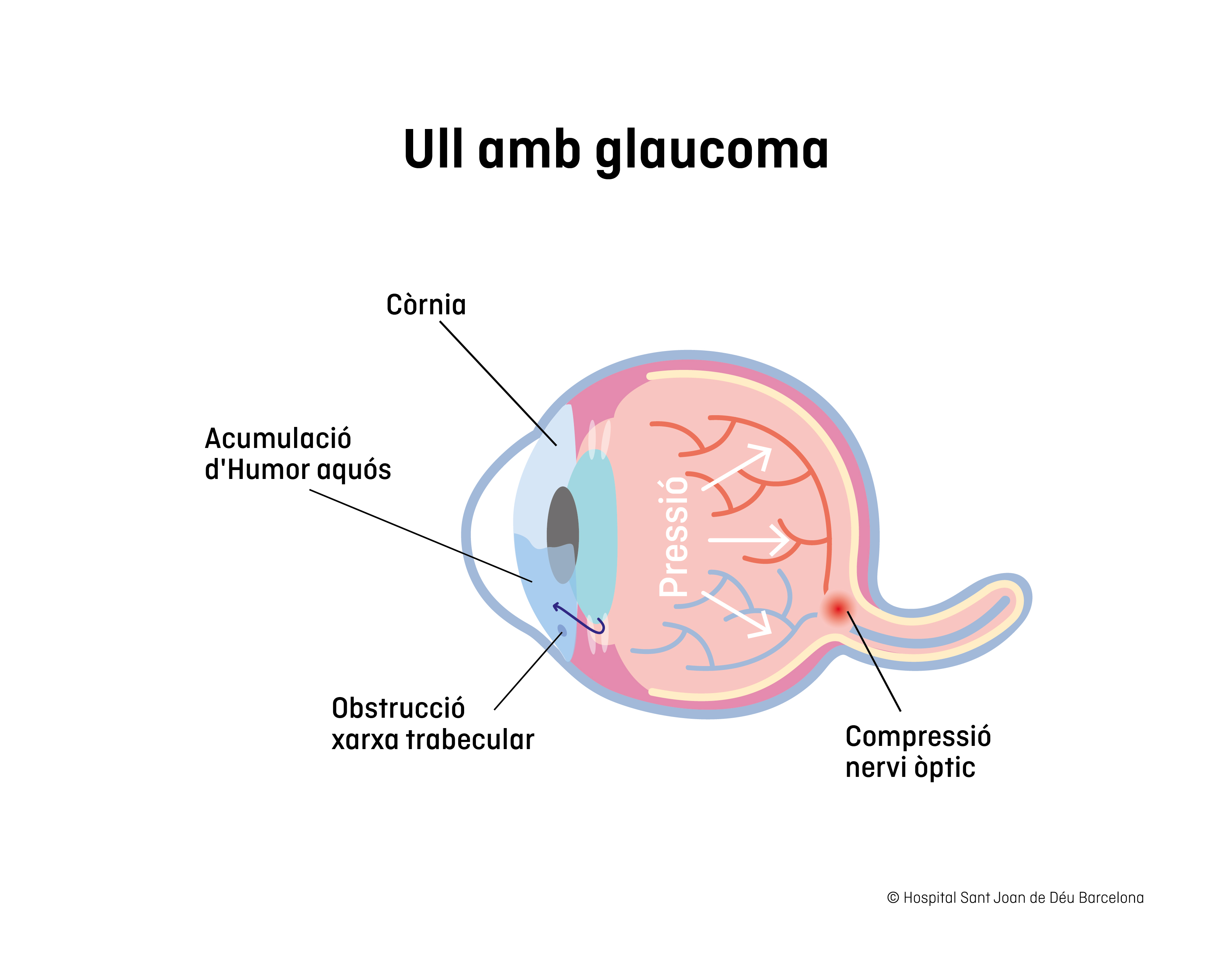 Glaucoma