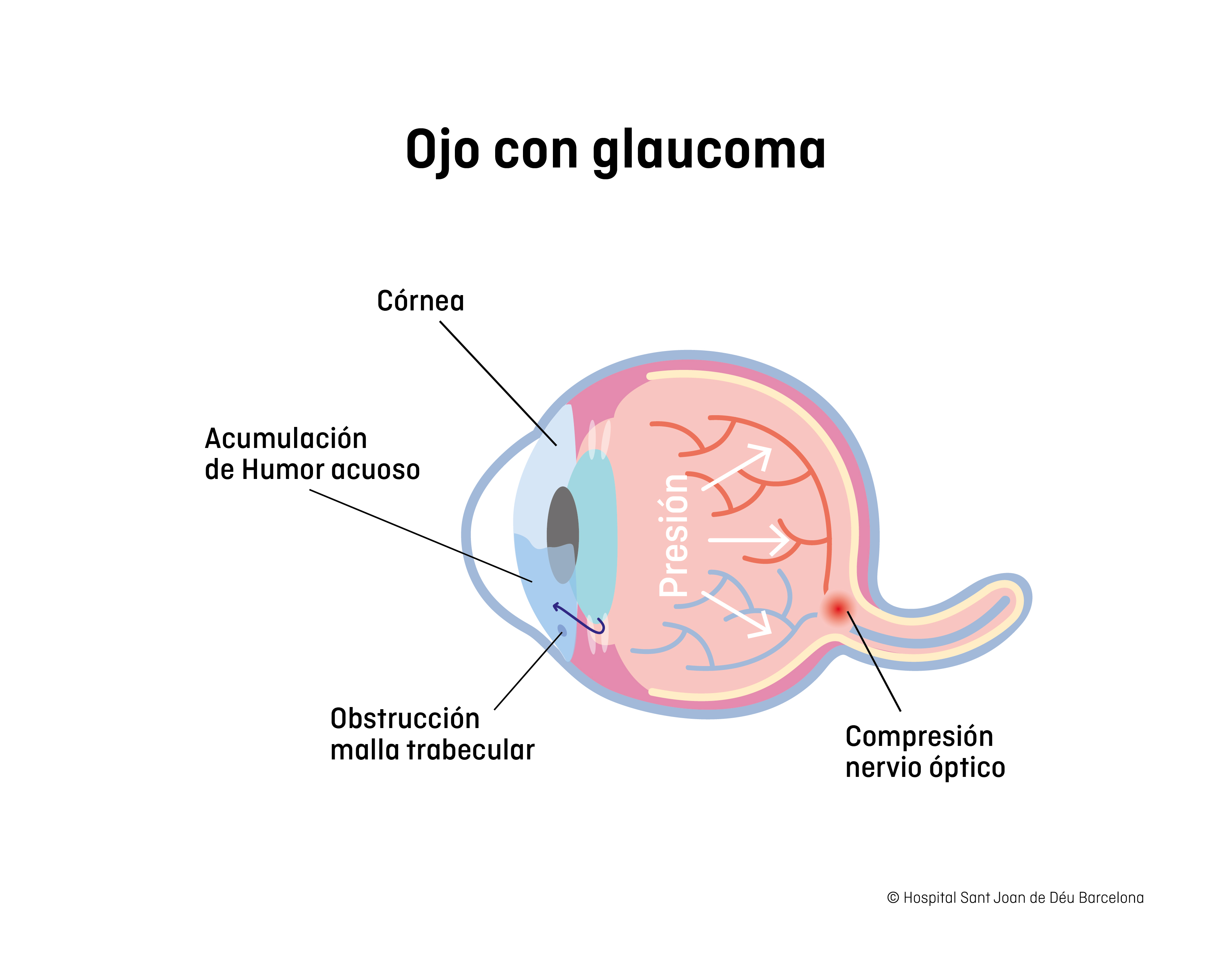 Glaucoma