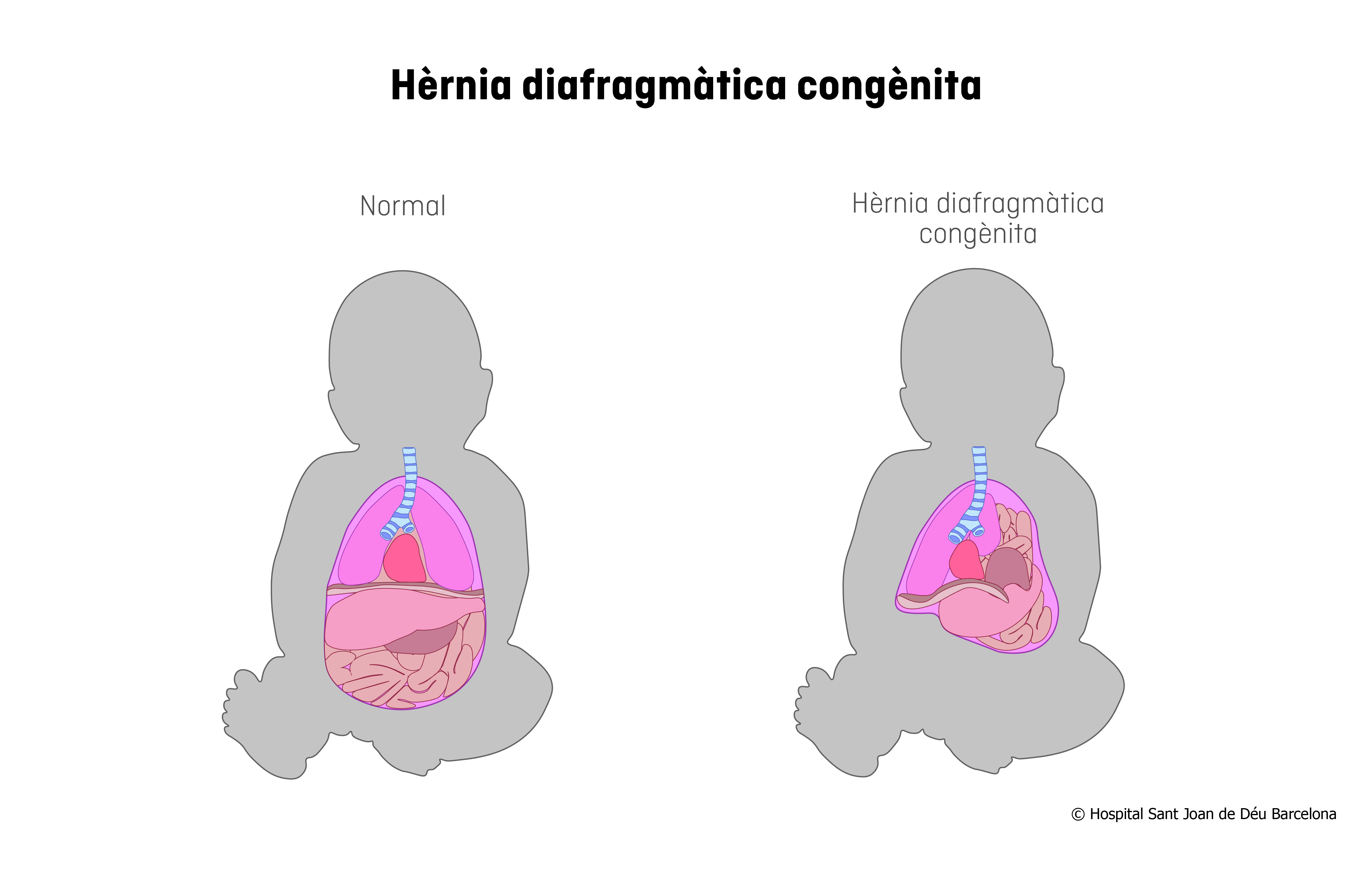 Hernia diafragmática congénita