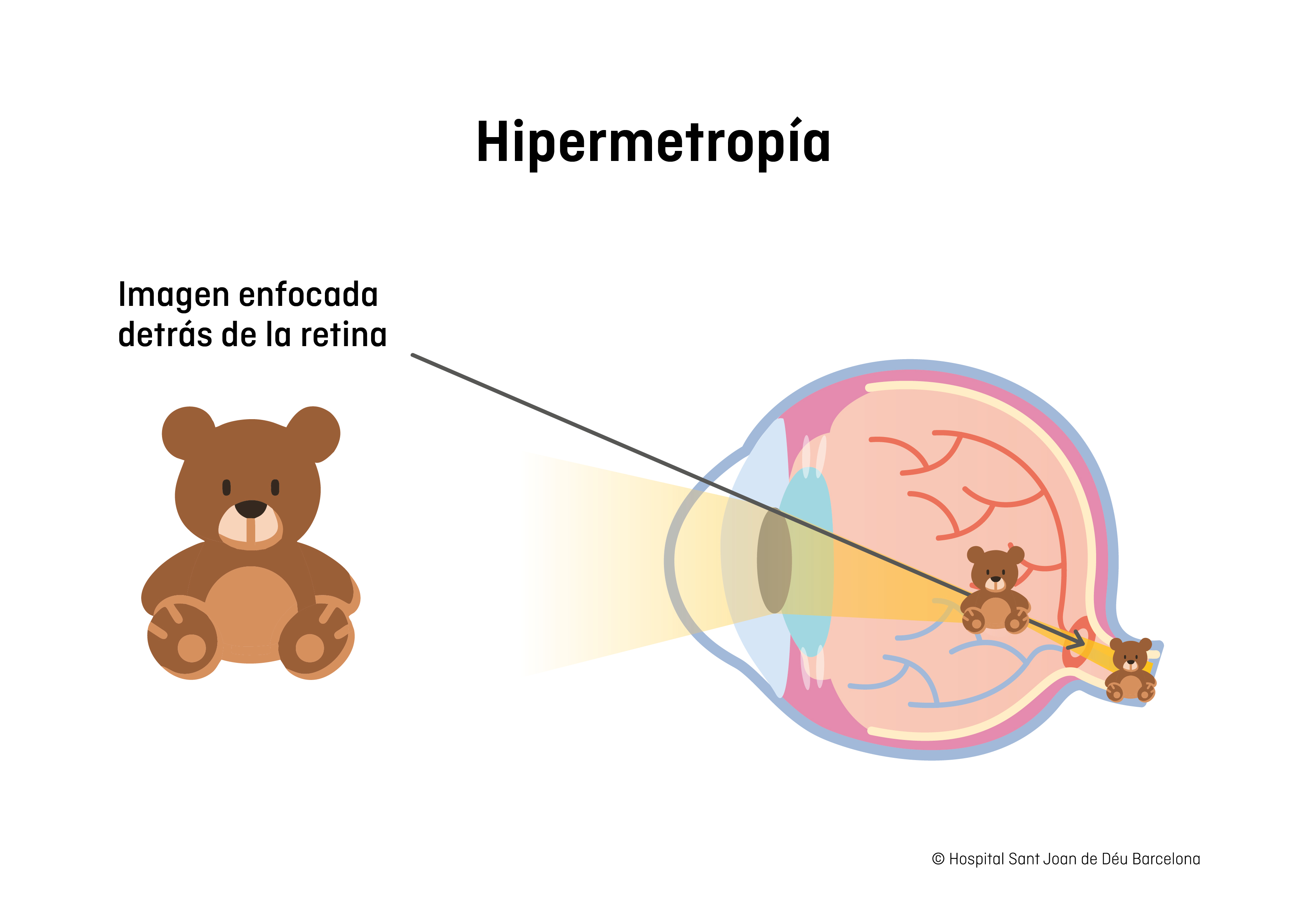 Hipermetropía