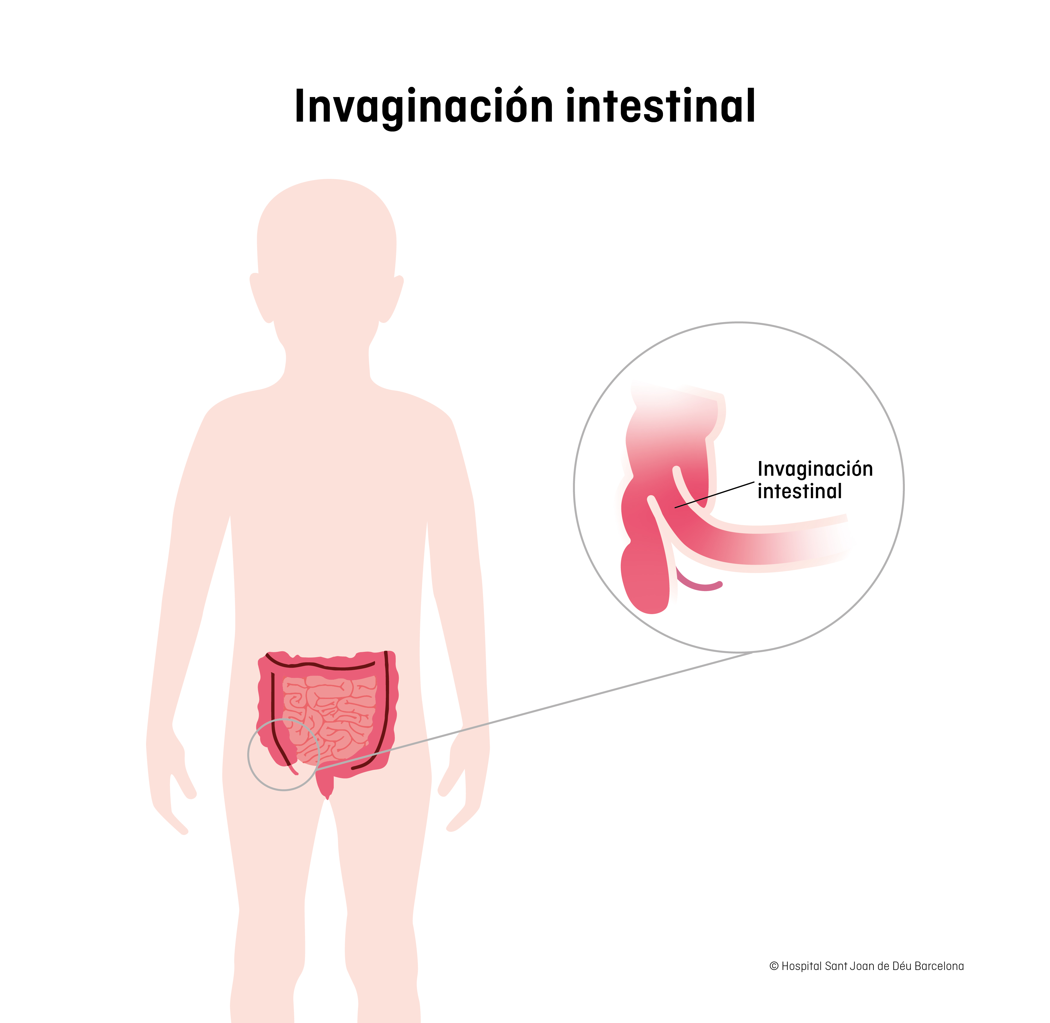 Invaginación intestinal