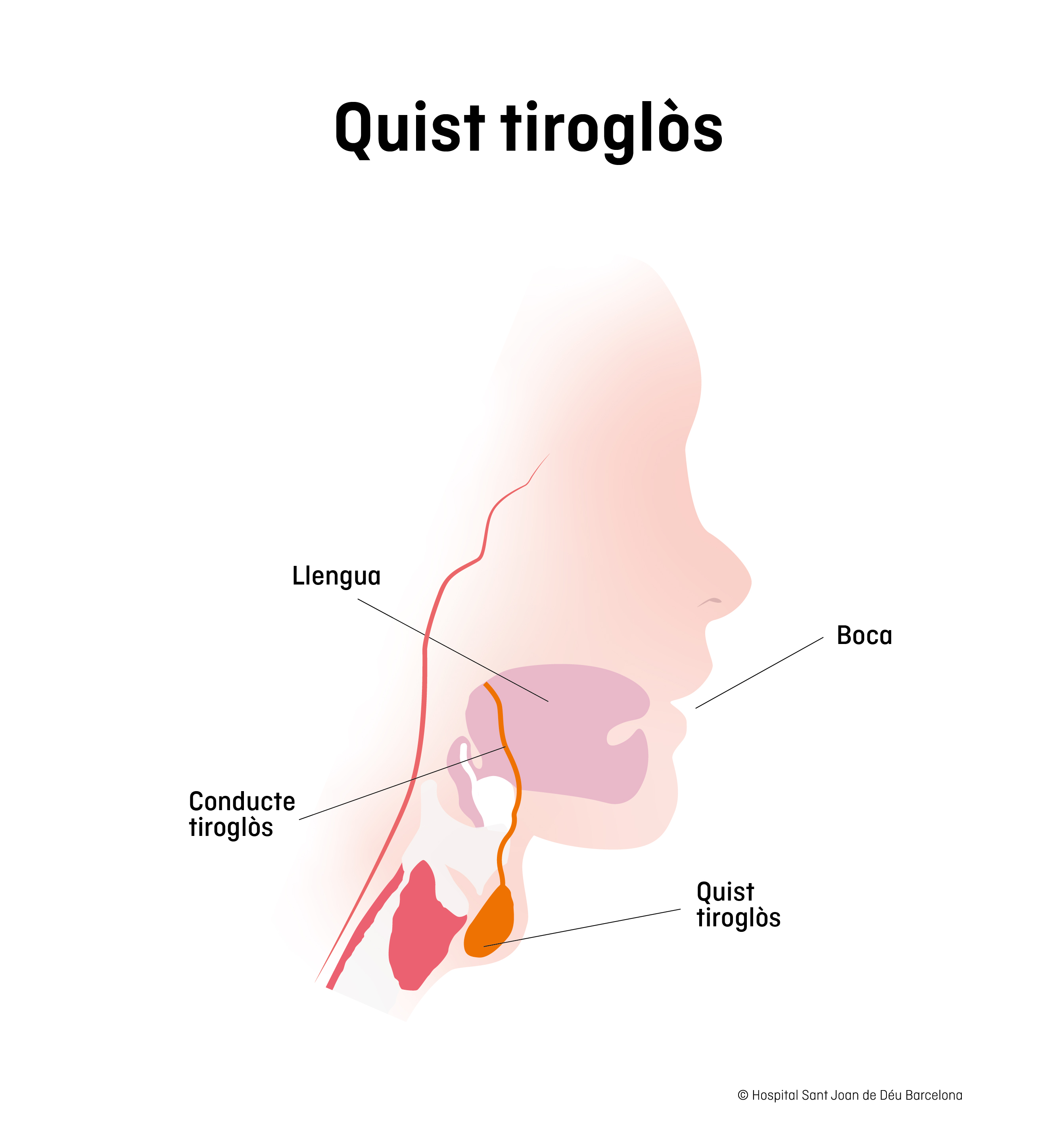  Dibuix del quist tiroglòs