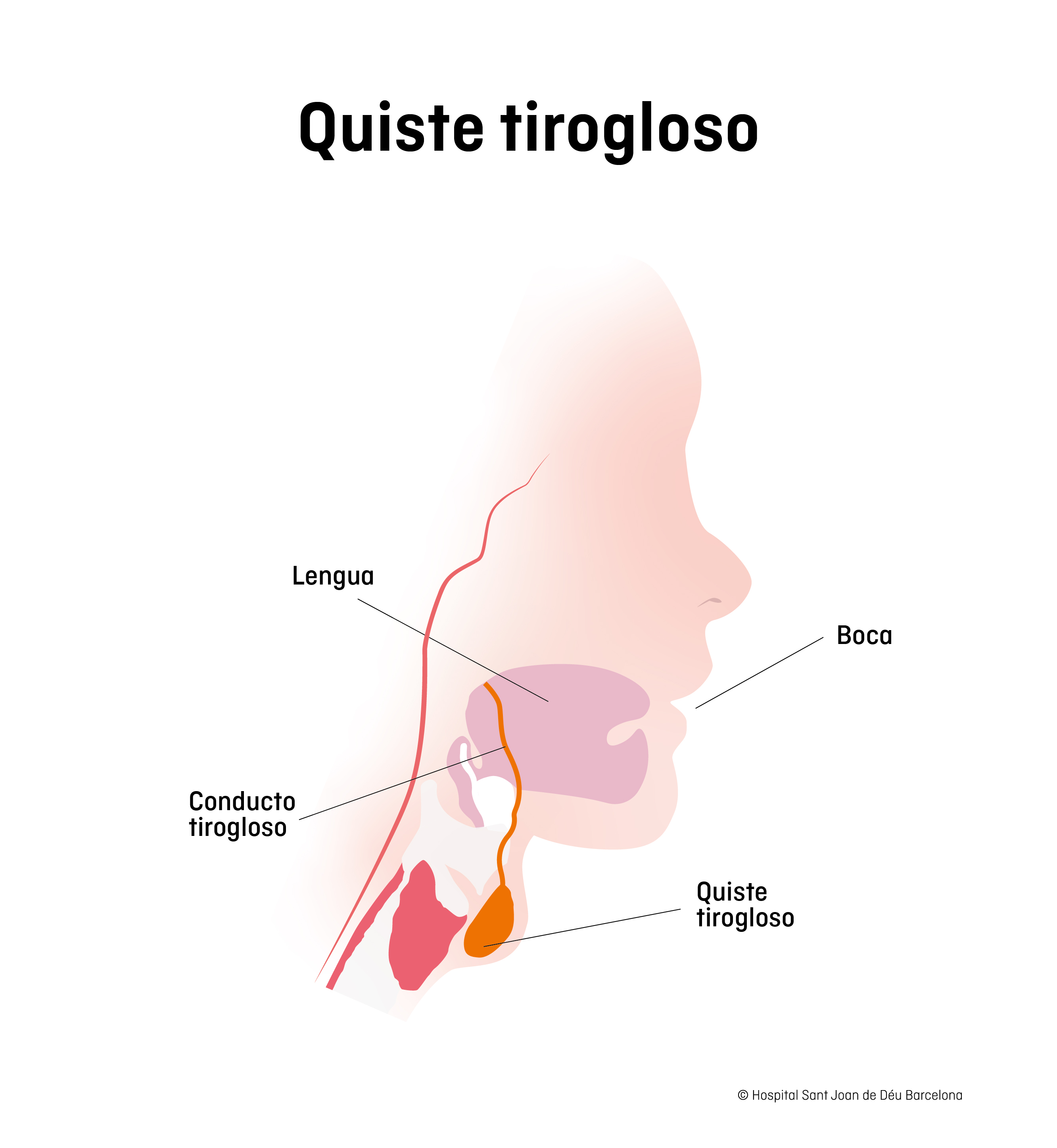 Dibujo del quiste tirogloso