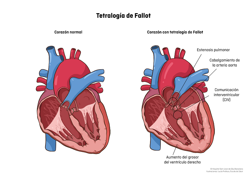 Tetralogia de fallot