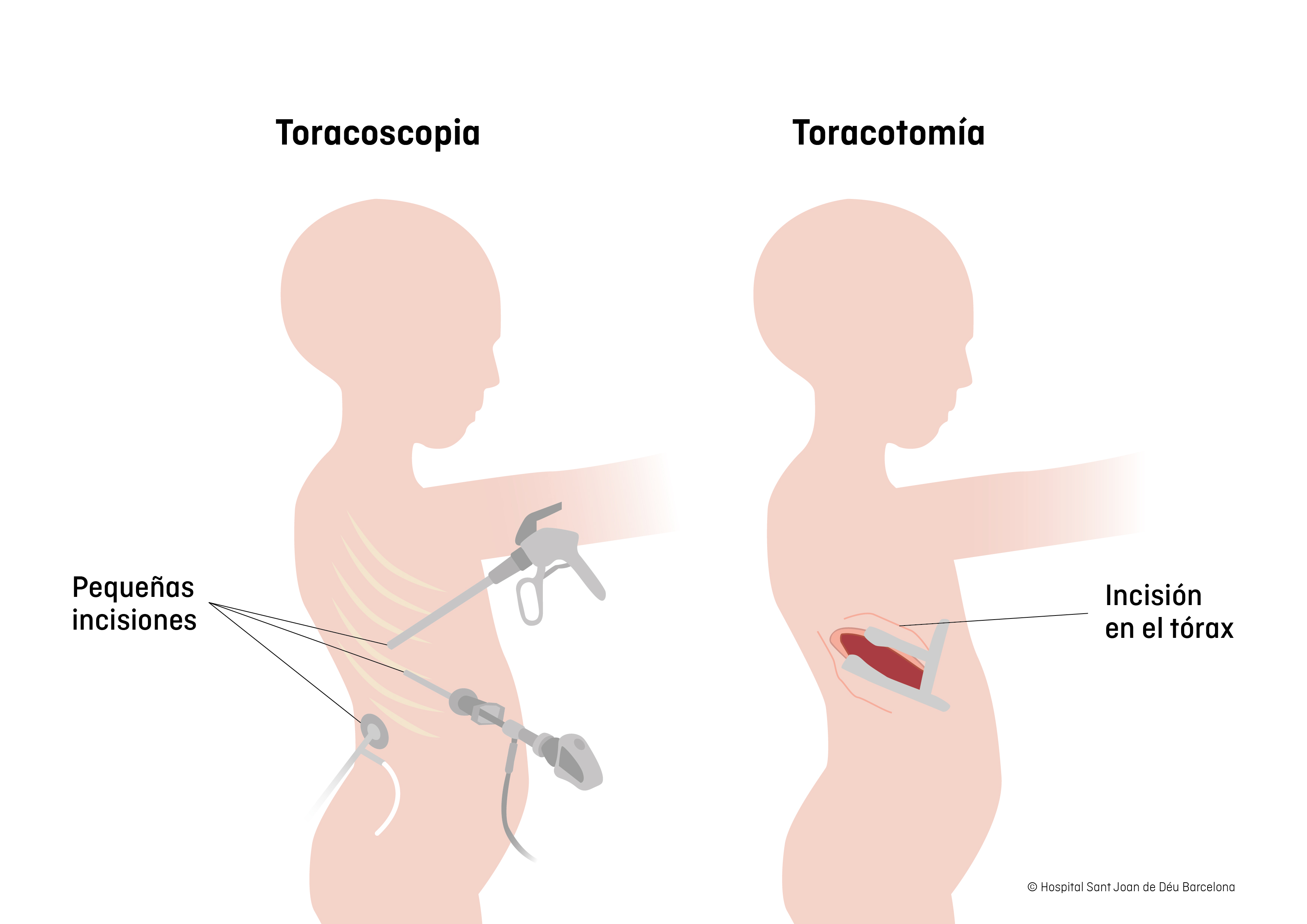 Toracoscopia y toracotomia