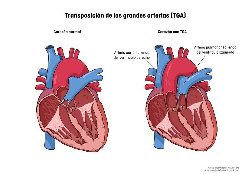 transposición de las grandes arterias