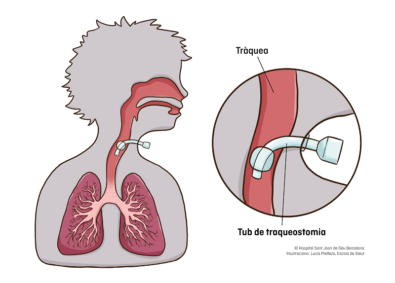 traqueostomia